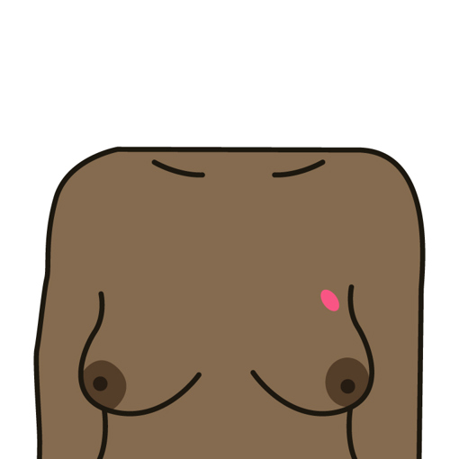 A lump or swelling in the breast, upper chest or armpit