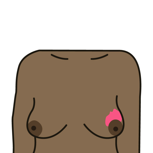 A change in the colour of the breast - may look darker, red or inflamed