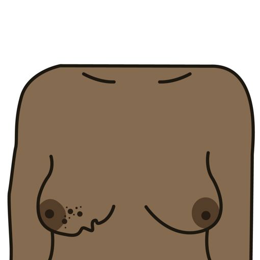 A change to the skin, such as puckering or dimpling 