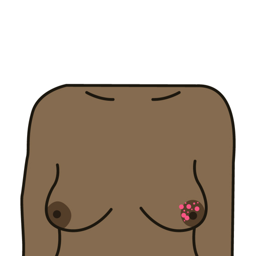 Rash or crusting around the nipple