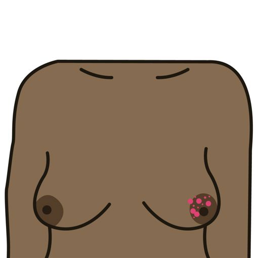 Rash or crusting around the nipple