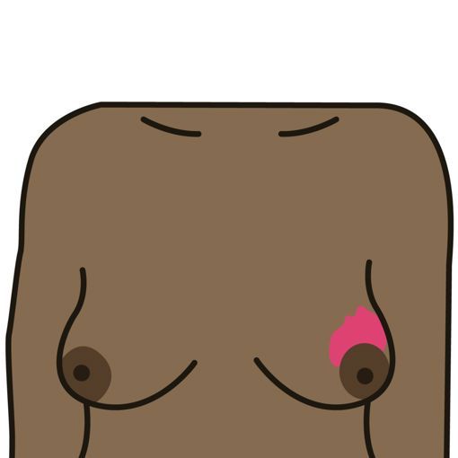 A change in the colour of the breast - may look darker, red or inflamed